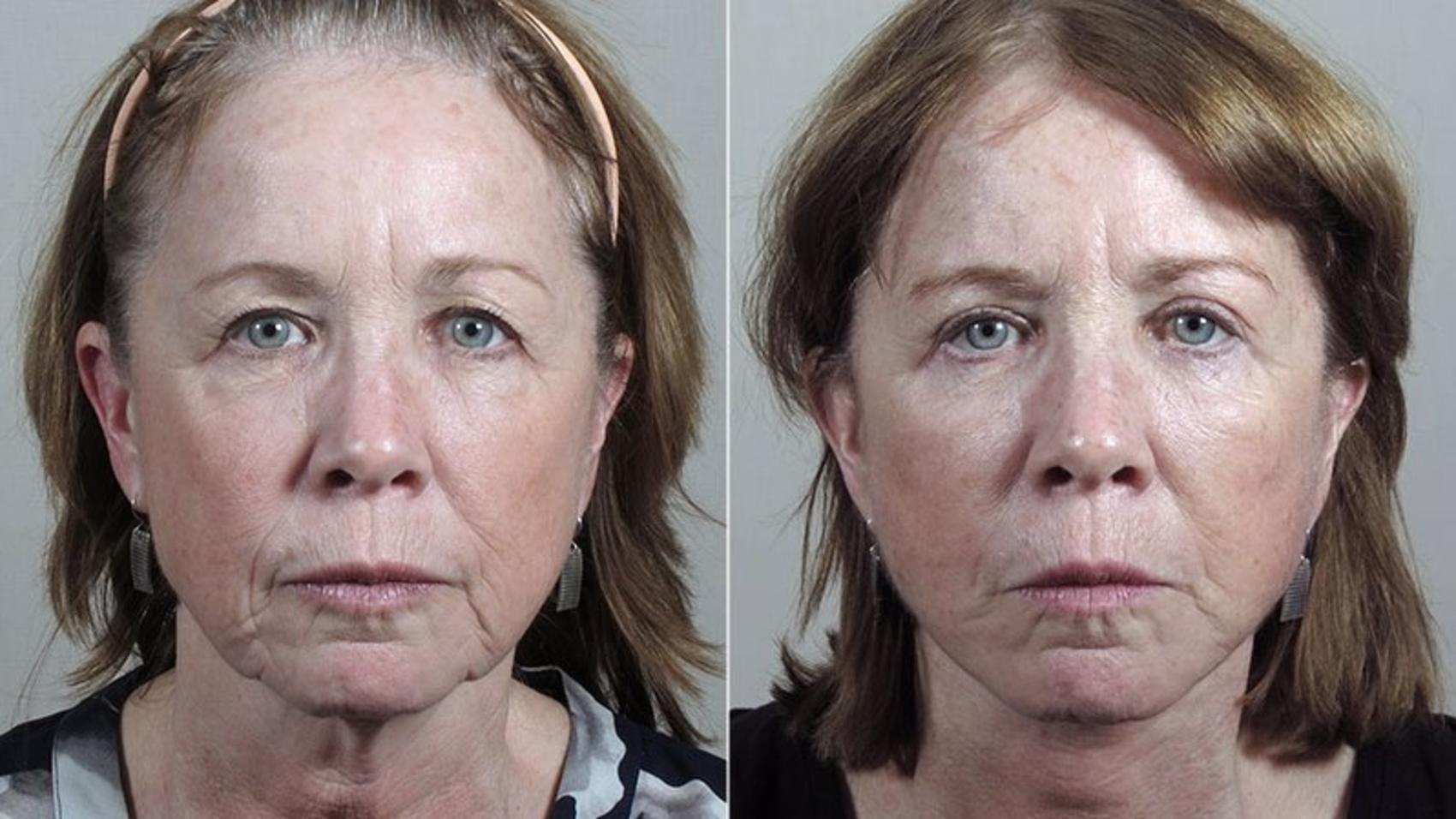 Facelift Case 42 Before & After View #1 | Paramus, NJ | Parker Center for Plastic Surgery