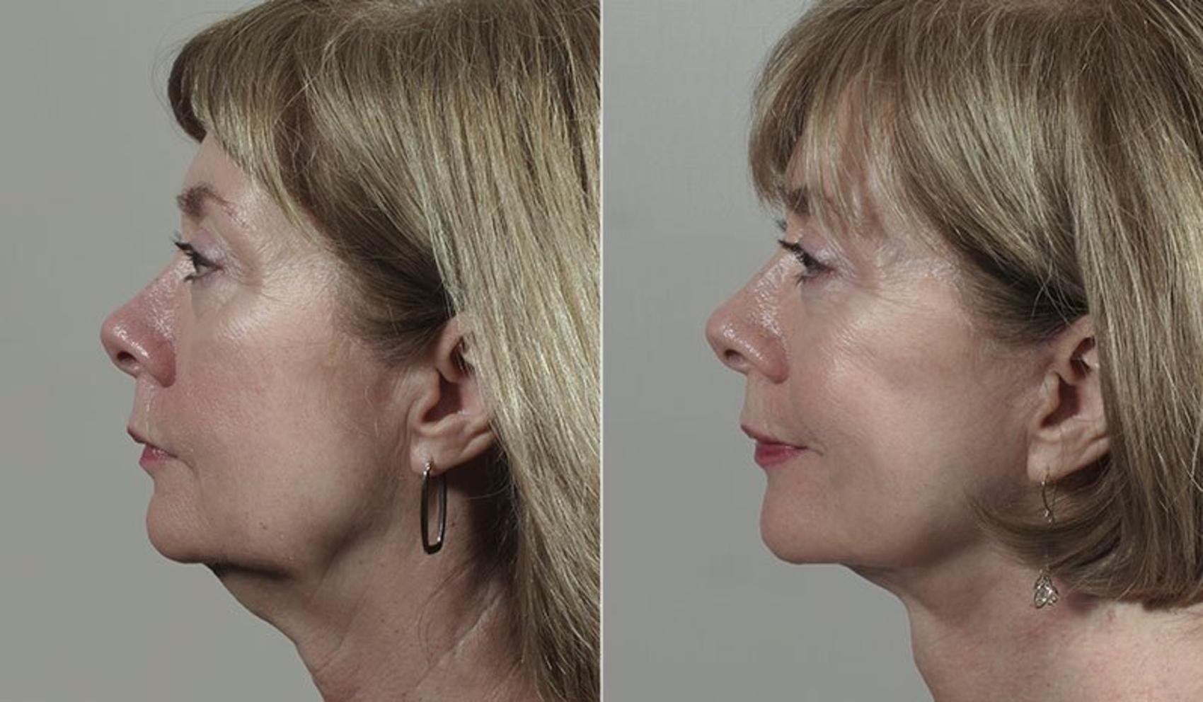 Facelift Case 43 Before & After View #2 | Paramus, New Jersey | Parker Center for Plastic Surgery