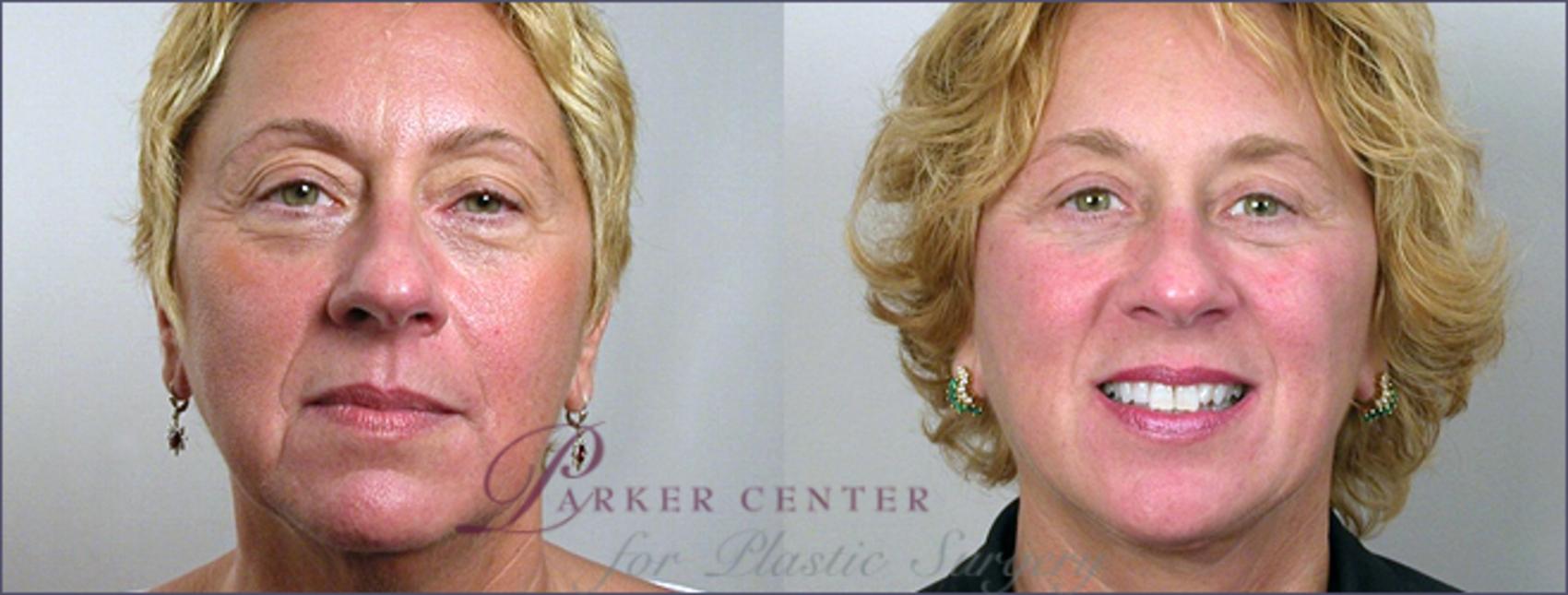 Facelift Case 5 Before & After View #1 | Paramus, NJ | Parker Center for Plastic Surgery