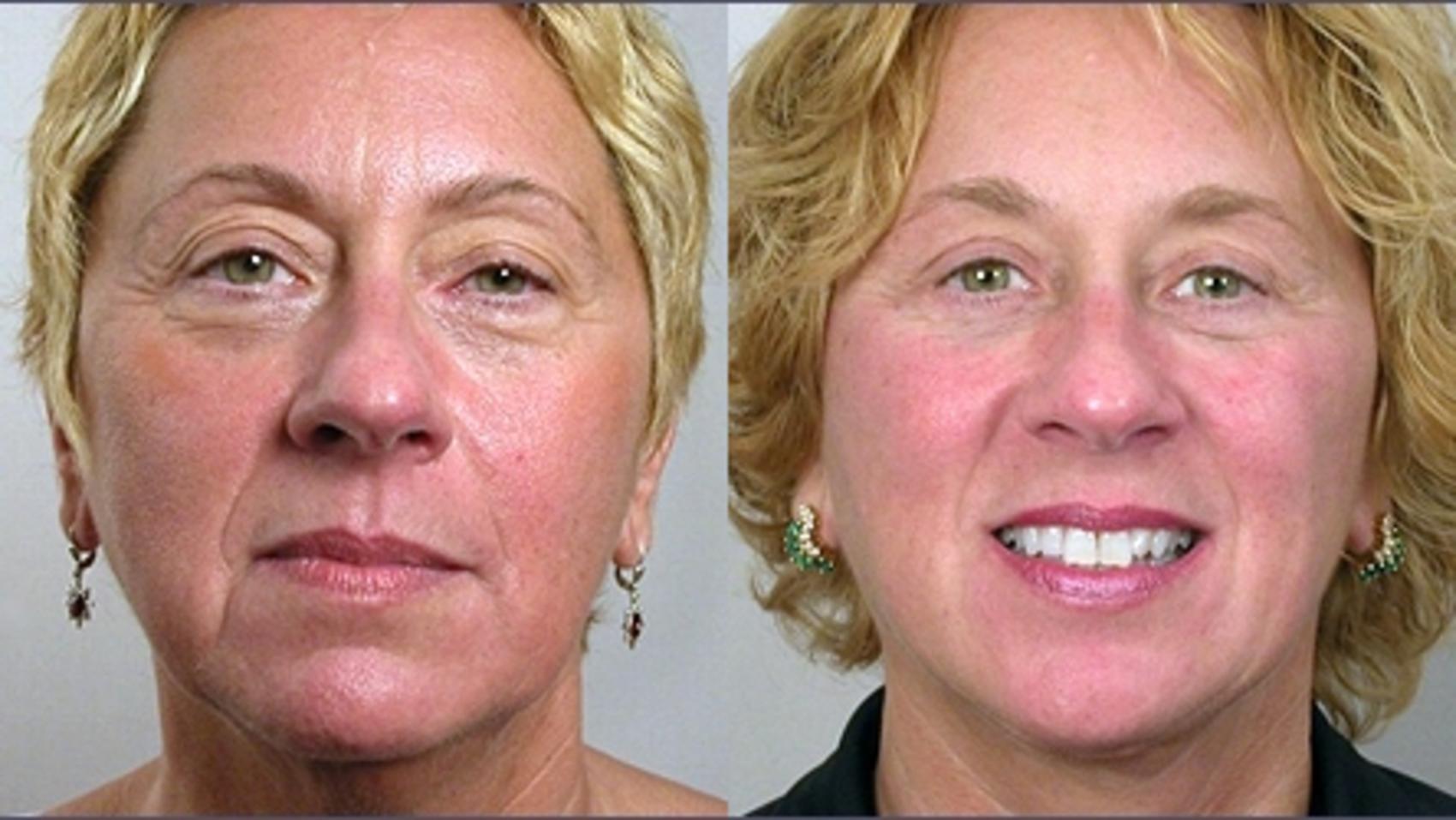 Facelift Before And After Pictures Case Paramus Nj Parker Center For Plastic Surgery