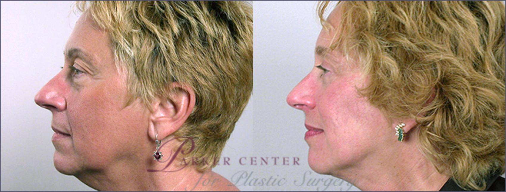 Facelift Case 5 Before & After View #2 | Paramus, NJ | Parker Center for Plastic Surgery