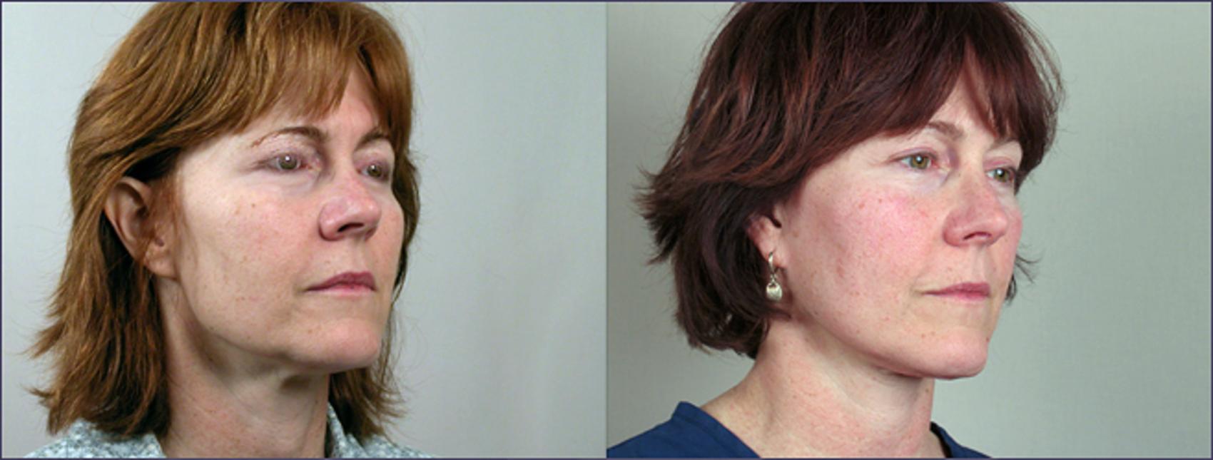 Facelift Case 6 Before & After View #1 | Paramus, NJ | Parker Center for Plastic Surgery