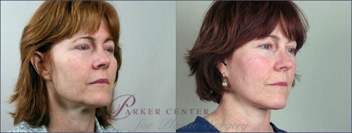 Facelift Case 6 Before & After View #1 | Paramus, NJ | Parker Center for Plastic Surgery