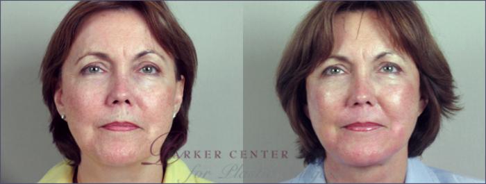 Facelift Case 7 Before & After View #1 | Paramus, NJ | Parker Center for Plastic Surgery