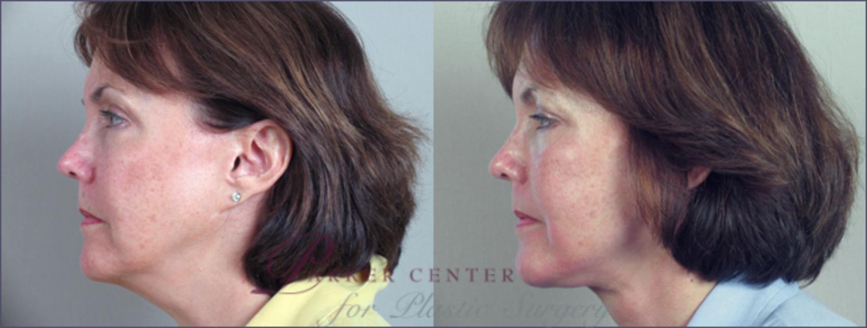 Nonsurgical Face Procedures Case 7 Before & After View #2 | Paramus, NJ | Parker Center for Plastic Surgery
