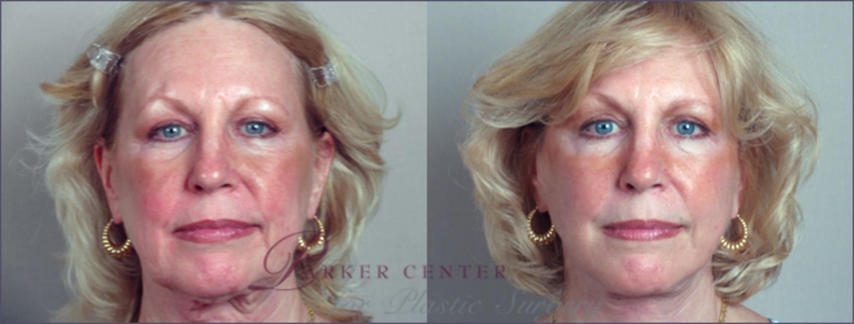 Facelift Case 8 Before & After View #1 | Paramus, NJ | Parker Center for Plastic Surgery