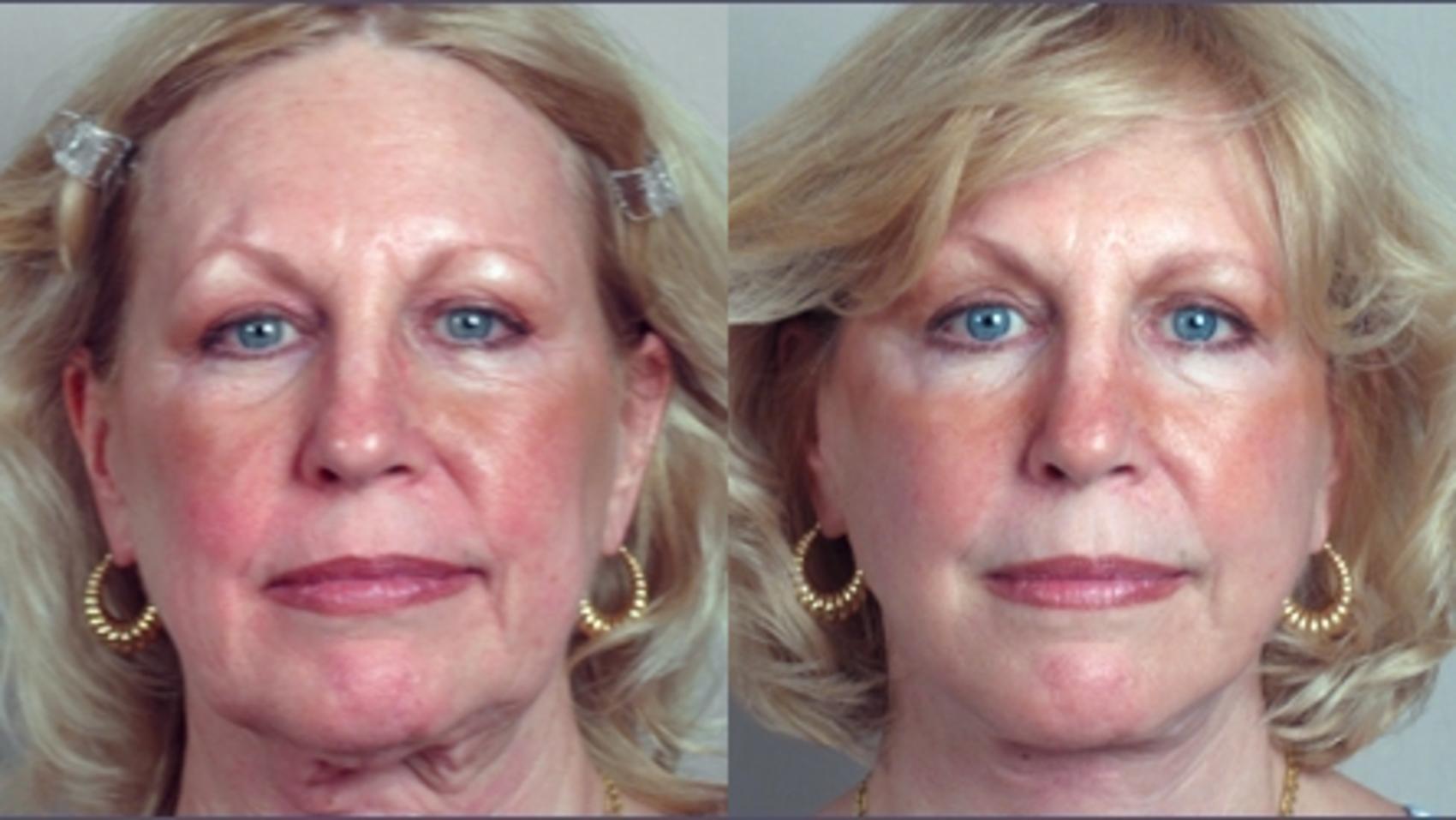 Facelift Case 8 Before & After View #1 | Paramus, NJ | Parker Center for Plastic Surgery