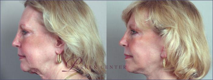 Facelift Case 8 Before & After View #2 | Paramus, NJ | Parker Center for Plastic Surgery