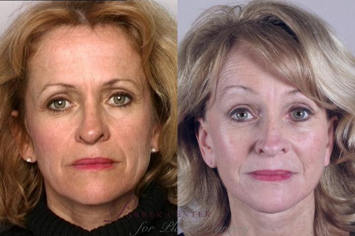 Brow Lift Case 847 Before & After front 10 year  | Paramus, NJ | Parker Center for Plastic Surgery