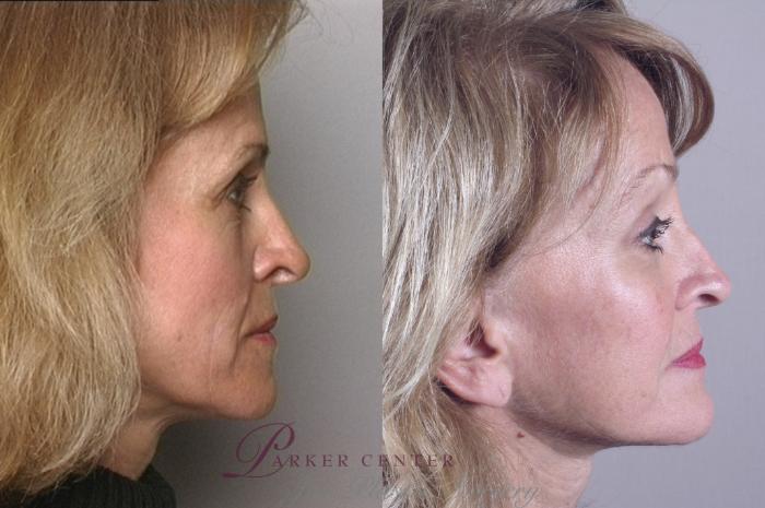 Brow Lift Case 847 Before & After left 10 year  | Paramus, NJ | Parker Center for Plastic Surgery