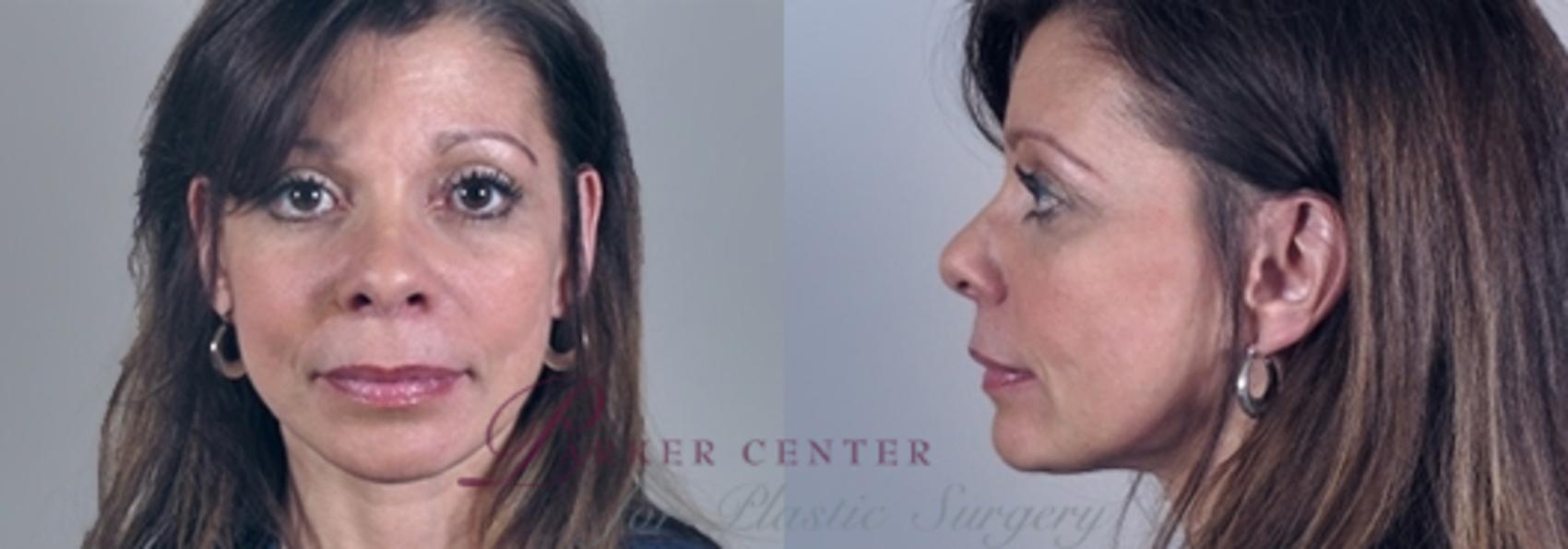 Eyelid Lift Case 848 Before & After View #1 | Paramus, NJ | Parker Center for Plastic Surgery