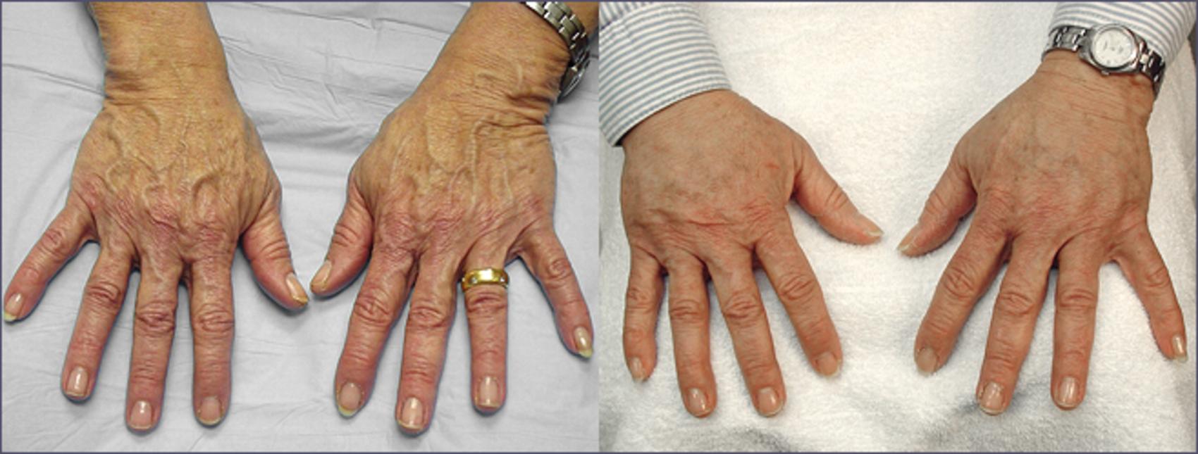 Hand Lift Case 843 Before & After View #1 | Paramus, NJ | Parker Center for Plastic Surgery