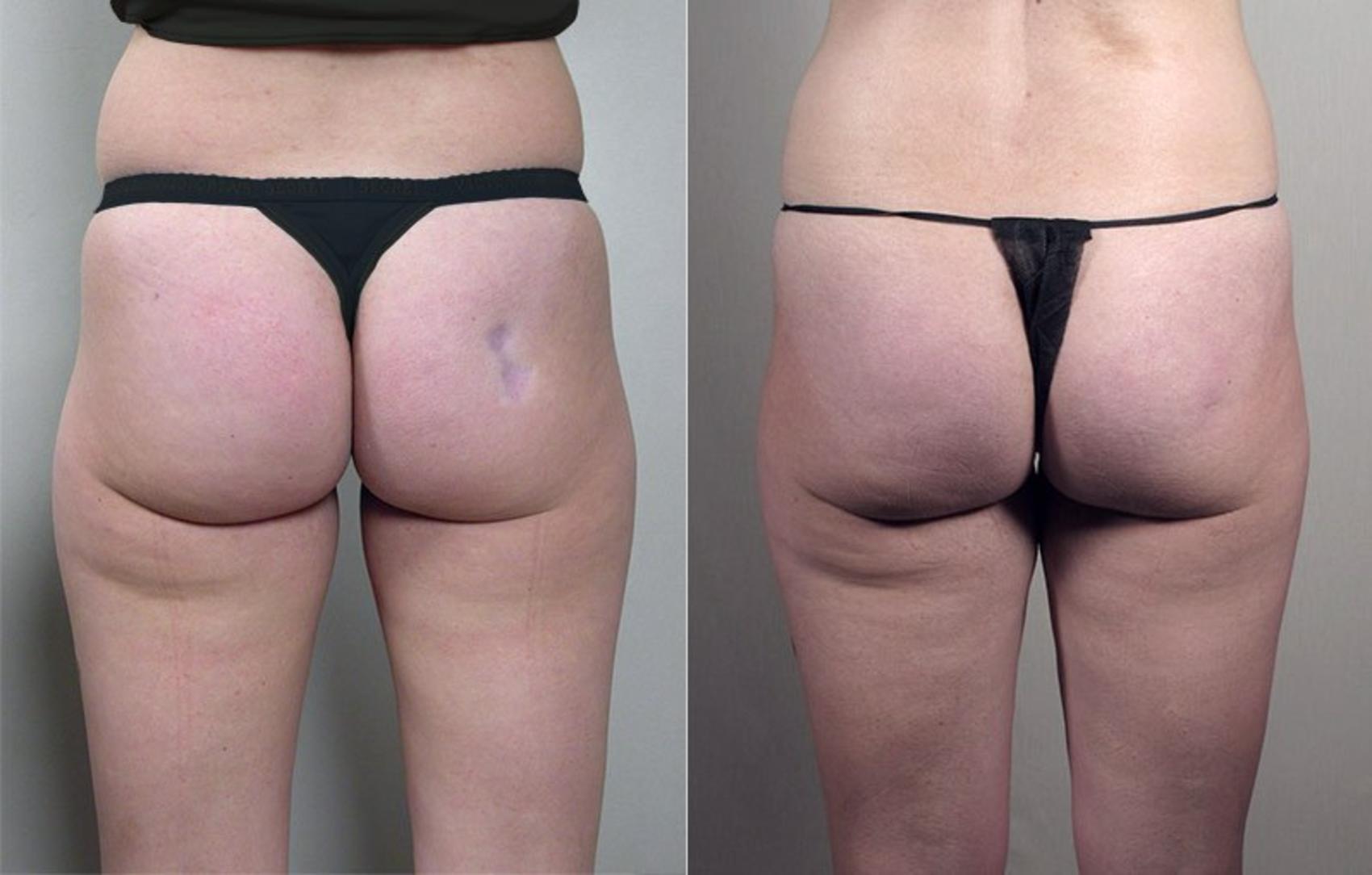 Fat Injection Before and After Pictures Case 844, Paramus, NJ