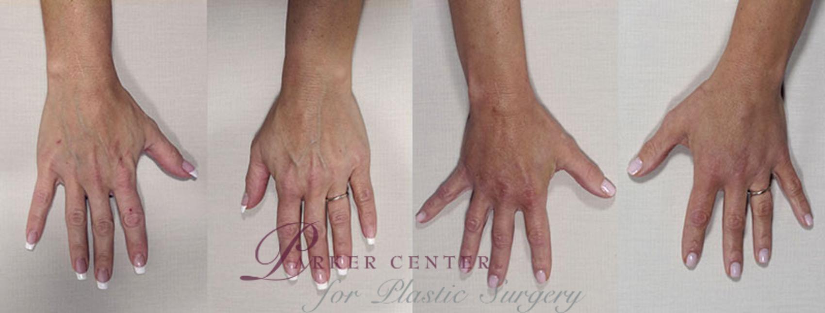 Hand Lift Case 846 Before & After View #1 | Paramus, NJ | Parker Center for Plastic Surgery