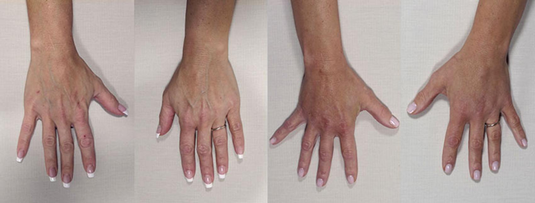 Hand Lift Case 846 Before & After View #1 | Paramus, NJ | Parker Center for Plastic Surgery