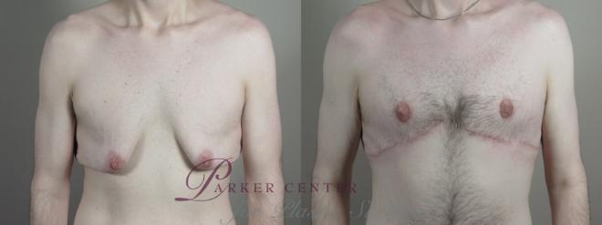 Gynecomastia Surgery Case 1010 Before & After Front | Paramus, NJ | Parker Center for Plastic Surgery
