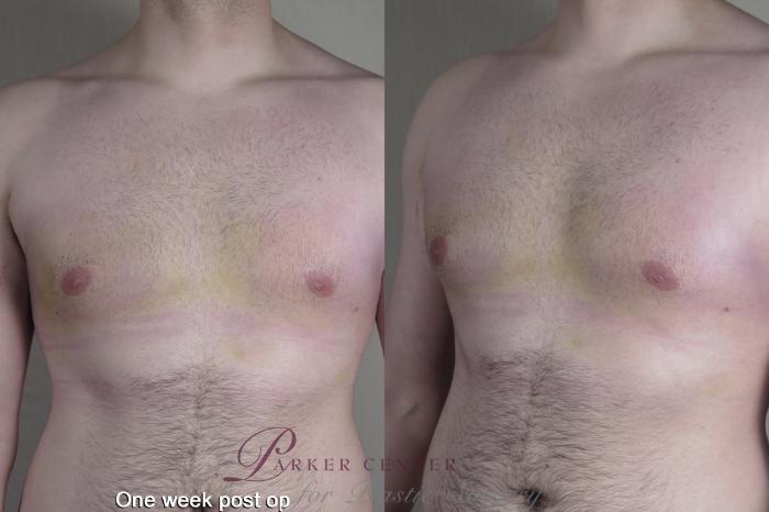 Gynecomastia Surgery Case 1368 Before & After 1 week  | Paramus, New Jersey | Parker Center for Plastic Surgery