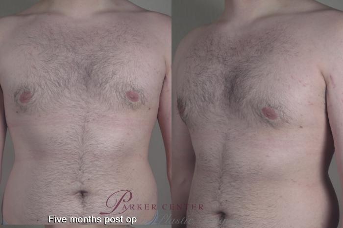 Gynecomastia Surgery Case 1368 Before & After months  | Paramus, New Jersey | Parker Center for Plastic Surgery