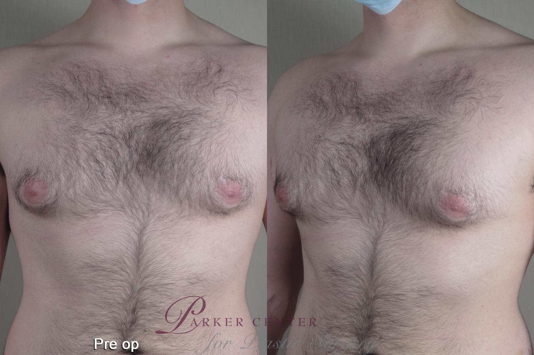 Gynecomastia Surgery Case 1368 Before & After pre op  | Paramus, New Jersey | Parker Center for Plastic Surgery