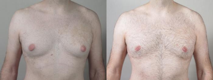 Gynecomastia Surgery Case 1530 Before & After Front | Paramus, New Jersey | Parker Center for Plastic Surgery