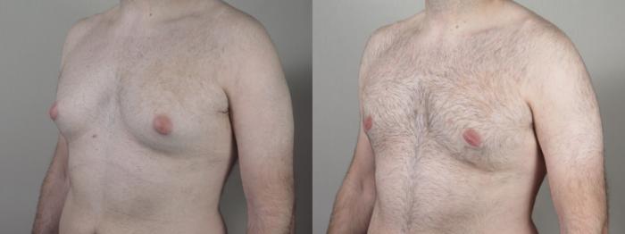 Gynecomastia Surgery Case 1530 Before & After Left Oblique | Paramus, New Jersey | Parker Center for Plastic Surgery