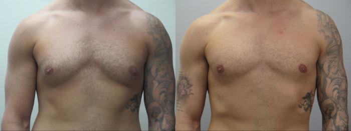Gynecomastia Surgery Case 1563 Before & After Front | Paramus, New Jersey | Parker Center for Plastic Surgery