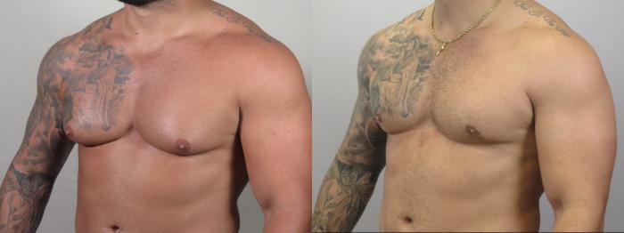 Gynecomastia Surgery Case 1593 Before & After Left Oblique | Paramus, New Jersey | Parker Center for Plastic Surgery