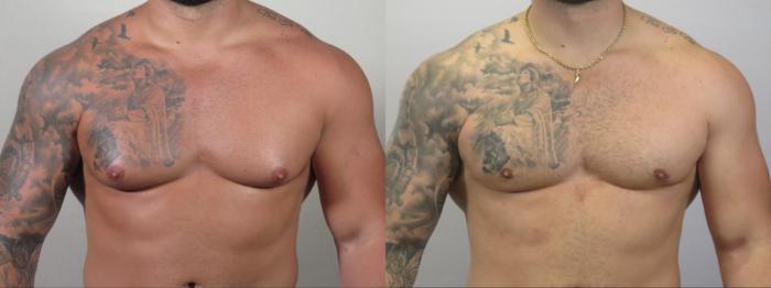 Gynecomastia Surgery Case 1593 Before & After Left Side | Paramus, New Jersey | Parker Center for Plastic Surgery