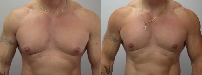 Gynecomastia Surgery Case 1618 Before & After Front | Paramus, New Jersey | Parker Center for Plastic Surgery