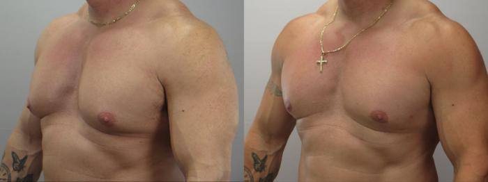 Gynecomastia Surgery Case 1618 Before & After left oblique | Paramus, New Jersey | Parker Center for Plastic Surgery
