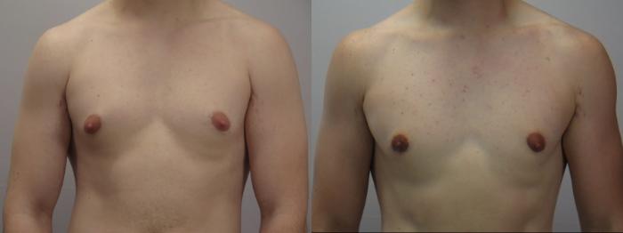 Gynecomastia Surgery Case 1623 Before & After front 1 | Paramus, New Jersey | Parker Center for Plastic Surgery