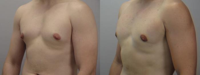 Gynecomastia Surgery Case 1623 Before & After Left Oblique | Paramus, New Jersey | Parker Center for Plastic Surgery