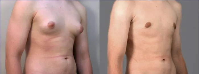 How To Tell if You Have Gynecomastia - Park Meadows Cosmetic Surgery