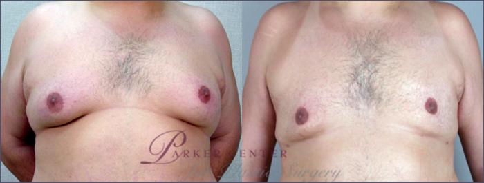 Gynecomastia Surgery Case 614 Before & After View #1 | Paramus, NJ | Parker Center for Plastic Surgery