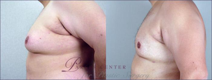 Gynecomastia Surgery Case 614 Before & After View #2 | Paramus, NJ | Parker Center for Plastic Surgery