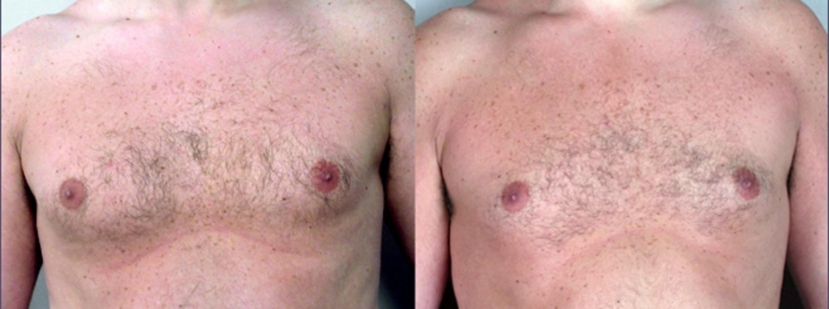 Gynecomastia Surgery Case 615 Before & After View #1 | Paramus, New Jersey | Parker Center for Plastic Surgery