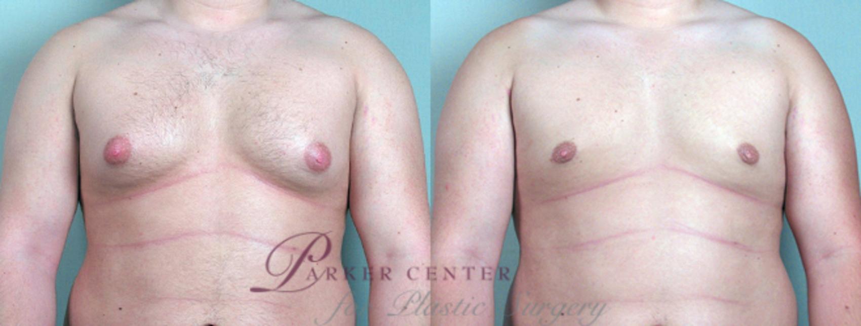 Gynecomastia Surgery Case 616 Before & After View #1 | Paramus, NJ | Parker Center for Plastic Surgery