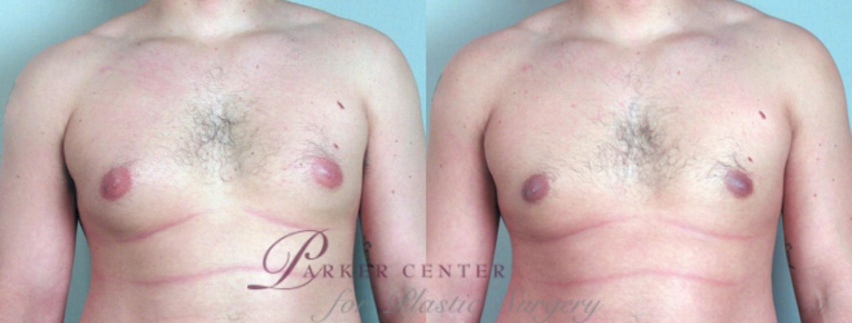 Gynecomastia Surgery Case 617 Before & After View #1 | Paramus, NJ | Parker Center for Plastic Surgery