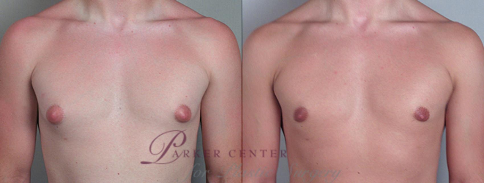 Gynecomastia Surgery Case 618 Before & After View #1 | Paramus, NJ | Parker Center for Plastic Surgery