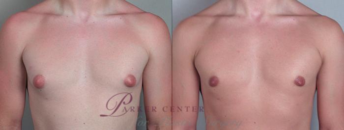 Gynecomastia Surgery Before and After Pictures Case 618, Paramus, NJ