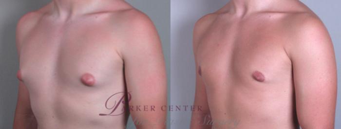 Gynecomastia Surgery Case 618 Before & After View #2 | Paramus, NJ | Parker Center for Plastic Surgery