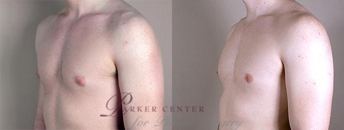 Gynecomastia Before & After, Case 10, Male, age 25 – 34
