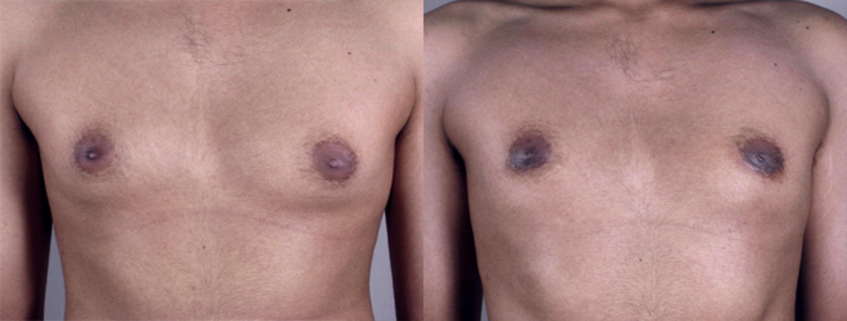 Gynecomastia Before & After Gallery: Patient 80