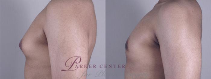 Gynecomastia Surgery Case 622 Before & After View #2 | Paramus, NJ | Parker Center for Plastic Surgery