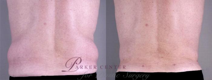 Gynecomastia Surgery Before and After Pictures Case 623