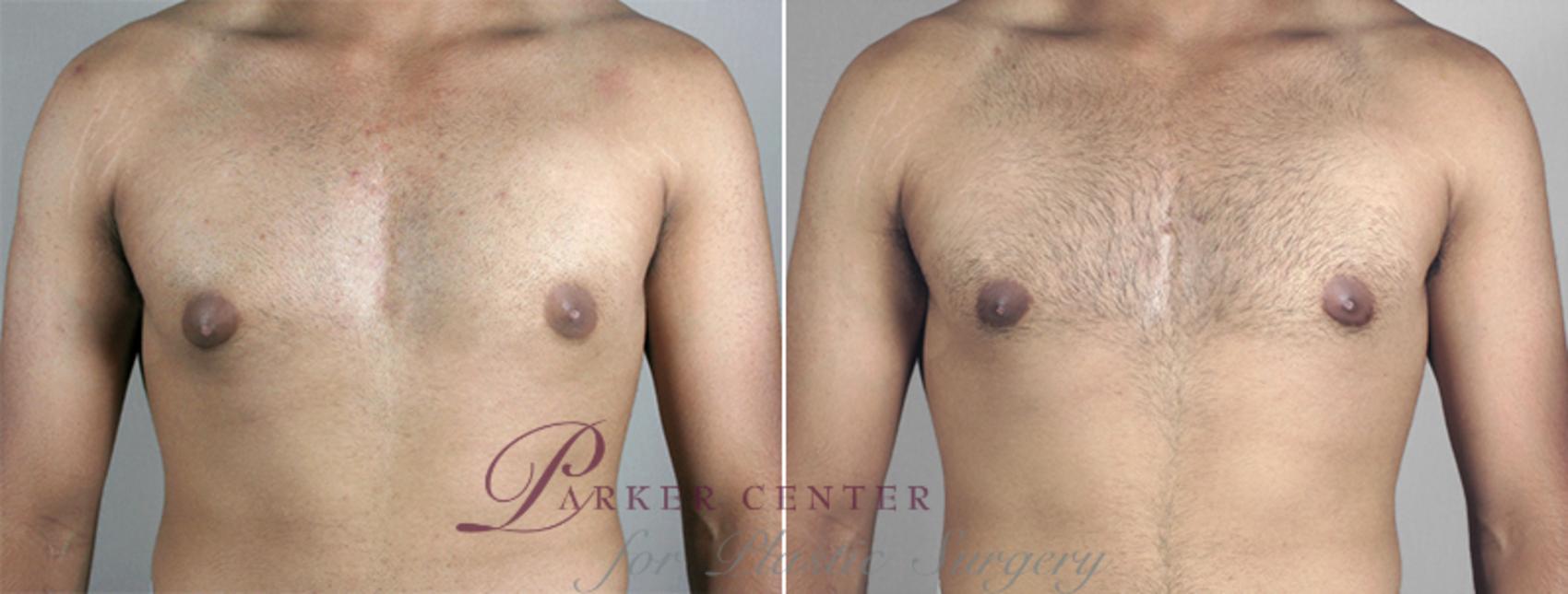 Gynecomastia Surgery Case 625 Before & After View #1 | Paramus, NJ | Parker Center for Plastic Surgery