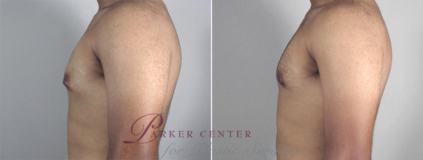 Gynecomastia Surgery Case 625 Before & After View #3 | Paramus, NJ | Parker Center for Plastic Surgery