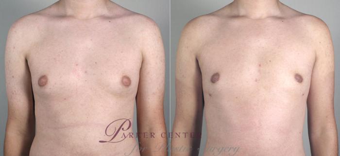 Liposuction Case 627 Before & After View #1 | Paramus, NJ | Parker Center for Plastic Surgery