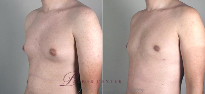 Liposuction Case 627 Before & After View #2 | Paramus, NJ | Parker Center for Plastic Surgery