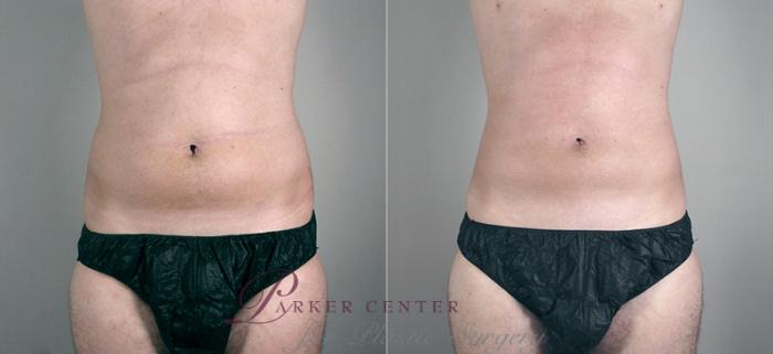 Liposuction Case 627 Before & After View #3 | Paramus, NJ | Parker Center for Plastic Surgery